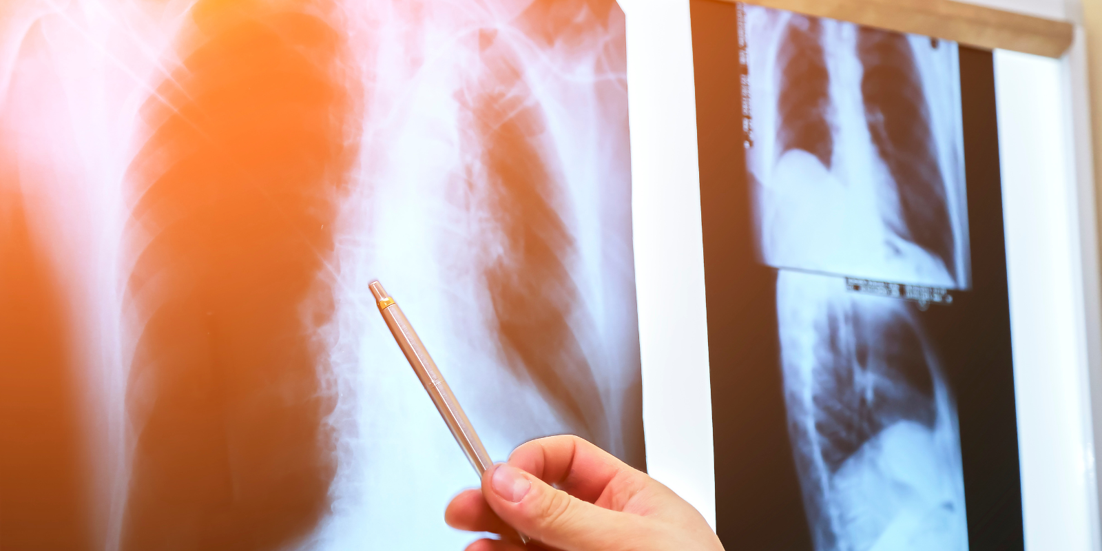 Lung x-ray